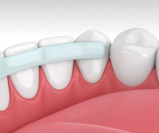 Cosmetic Dental Bonding