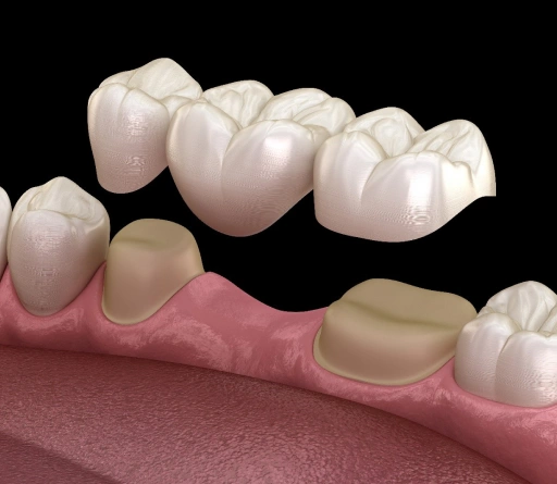 dental-bridges