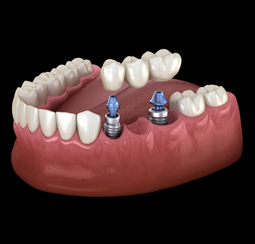 dental-implants