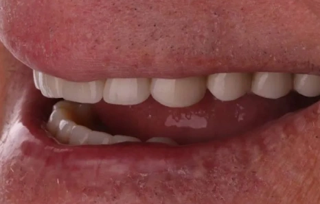 Img-full-mouth-reconstruction- AFTER 4