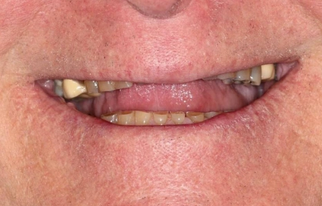 Img-full-mouth-reconstruction- BEFORE 1