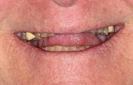 Img-full-mouth-reconstruction- BEFORE 2