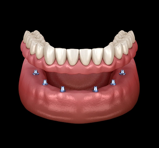 implant-supported-dentures