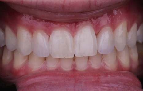 Img-porcelain-veneers- AFTER 1