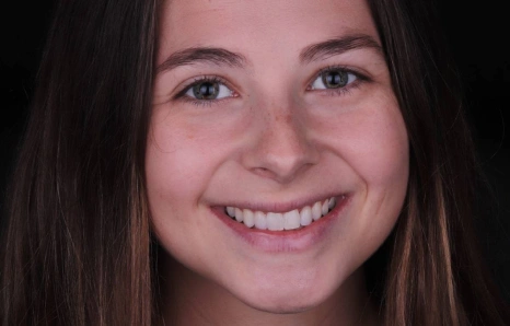 Img-porcelain-veneers- AFTER 4