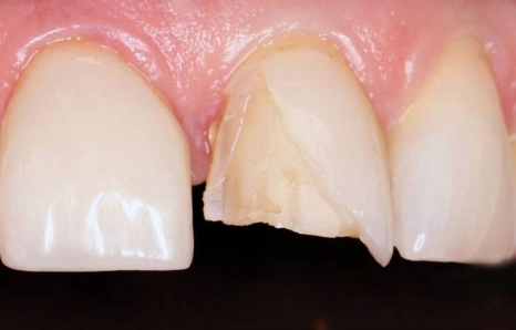 Img-porcelain-veneers- Before 2