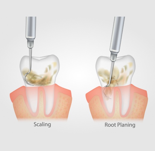 scaling-and-root-planing